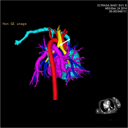 CT 3D showing posterior heart and circulation. This view focuses primarily on the anomalous branching and route of the pulmonary venous flow in relation to other vessels and airways nearby. The left-sided vertical vein can be seen traveling over the left bronchus (white arrow).
