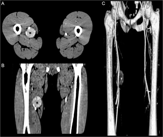 (A, B) Contrasted-enhanced CT scan shows a 4.1 × 4.3 × 4.6-cm mass (*) adjacent to the neurovascular bundle of the right thigh. (C) 3D reconstruction of the CT scan shows the displacement of the right femoral artery.