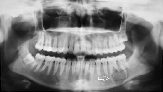 Radiologic diagnostics in two planes with panoramic X-ray. The panoramic radiograph showed a 2 × 1.8-cm radiolucent lesion of the left mandible. The lesion involved both apices of the first molar and the mesial apex of the second molar and extended to the caudal border of the mandibular bone.