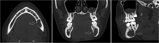 Axial, sagittal and coronar CT showing a 2 × 1 x 1.8-cm lesion in the left posterior mandible, its expansive and destructive character, and its penetration of the medial corticalis.