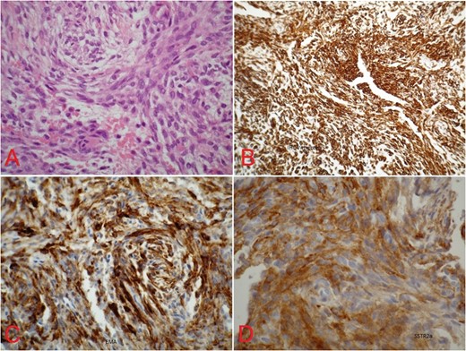 (A) Spindle-shaped cells arranged in cell cord and in whorls with no mitotic figures (hematoxylin–eosin, original magnification ×400). Immunhistochemical stains with immunopositive reaction for (B) vimentin (×100), (C) EMA (×400) and (D) somatostatin (×400).