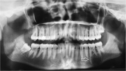Follow-up panoramic X-ray imaging at 12 months after initial diagnosis showing no significant progression of the tumor lesion.