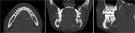 Likewise to panoramic X-ray, follow-up CT after 12 months showing no significant progression of the lesion.