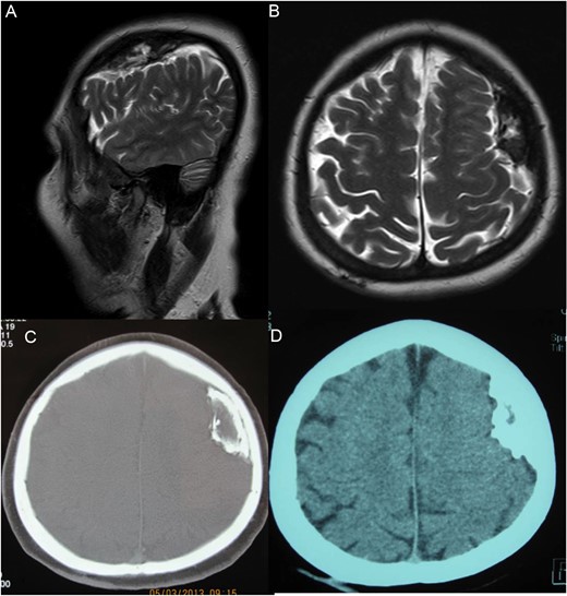 Cranial magnetic resonance (MR) and cranial CT images from a woman with an OSDH. (A) Pre-operative sagittal and axial (B) T2-weighted MR images demonstrating an ossified subdural mass in the left frontoparietal region. Pre-operative CT scan showing bone (C) and brain matter (D) of the ossified subdural mass that was located in the left frontoparietal region. Note that the mass has outer and inner rims and a slightly hypodense central part.