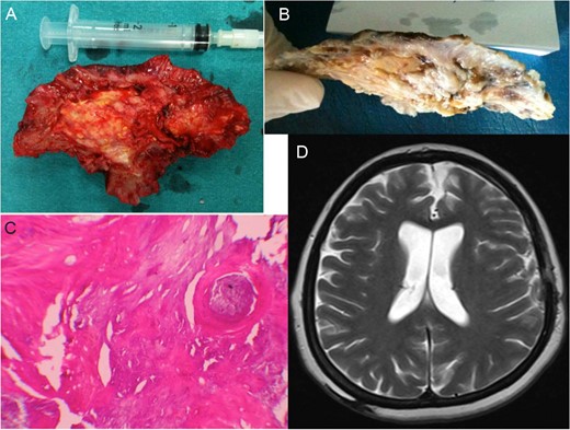 The peri-operative macroscopic appearance of the OSDH (A). Macroscopic appearance of the OSDH after formaldehyde fixation (B). Microscopic examination of the specimen stained with hematoxylin and eosin, original magnification ×100. In addition to the calcification areas, there is an area of irregular ossification with trabeculation (C). Six months after the operation: axial T2-weighted magnetic resonance images of the patient are normal (D).