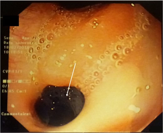 Fibroscopy: a 5-mm fistulous hole on the high part of the stomach.