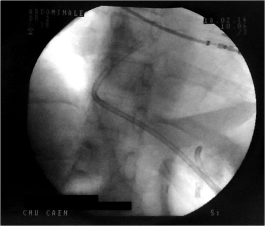 Control X-ray after the double pigtailed drain has been put up.