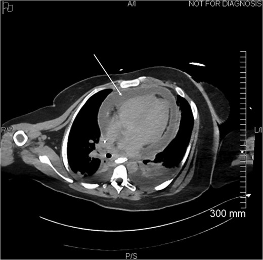Circumferential pericardial effusion (arrow).