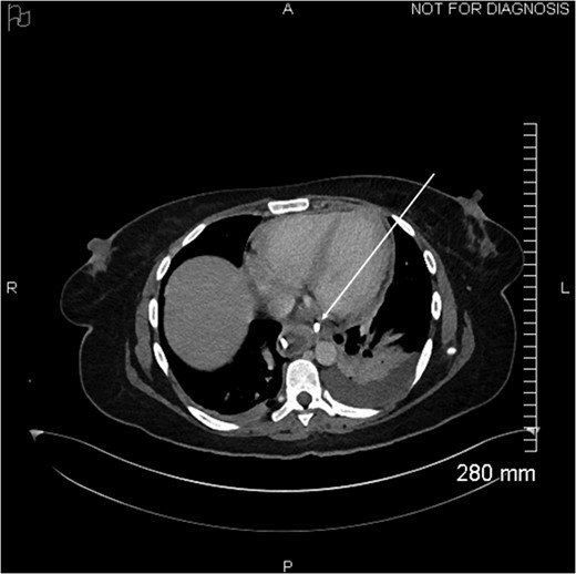 Proximal end of the double pigtail drain externalizes in the pericardium (arrow).