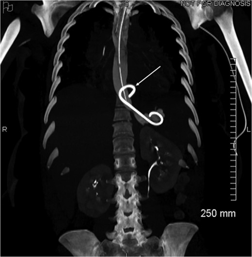 Coronal view of opacification on CT showing the externalization of the drain in the pericardium (arrow).
