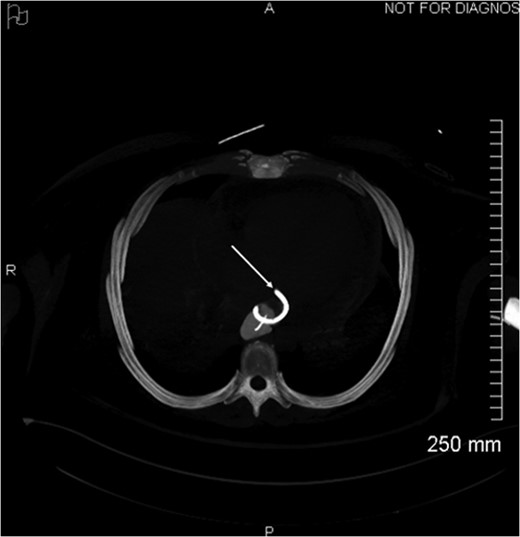 Axial view of opacification on CT showing the externalization of the drain in the pericardium (arrow).