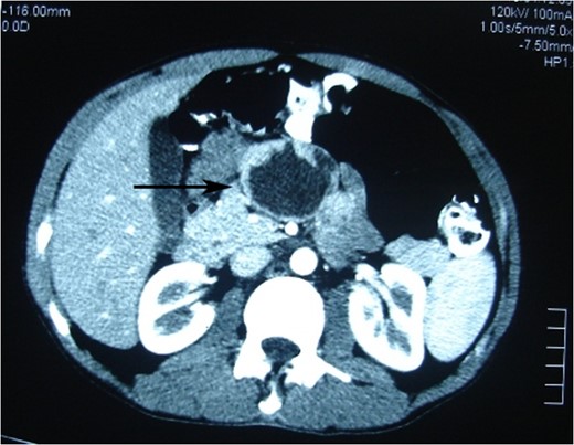 Photomicrograph of the arterial phase CT showing well-circumscribed low attenuated lesion (arrow).