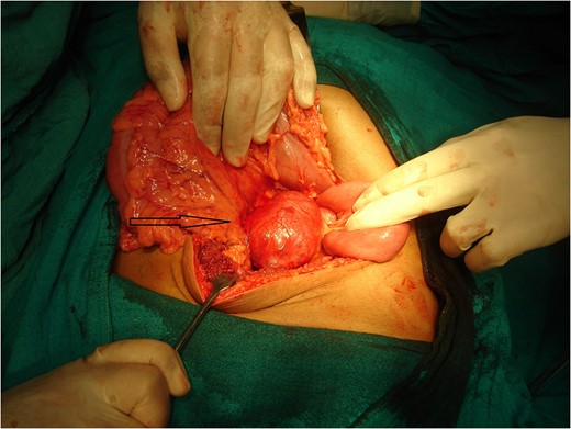 A photograph during laparotomy showing the origin of the lesion (arrow) at the root of mesentery medial to the duodenojenunal flexure.