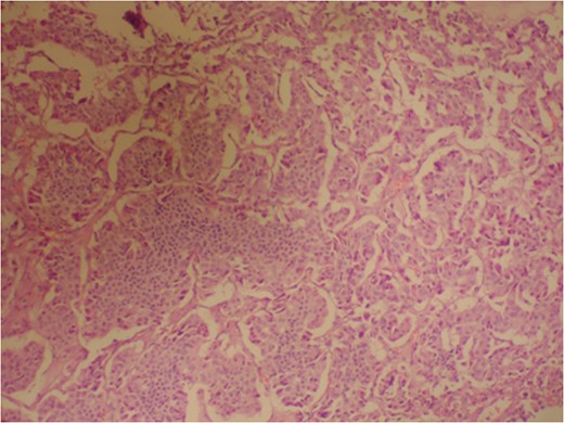 Photomicrograph indicating the tumor composed of irregular pseudopapillary structures; prominent myxoid changes can be seen in the stroma. (hematoxylin and eosin stain, ×200).