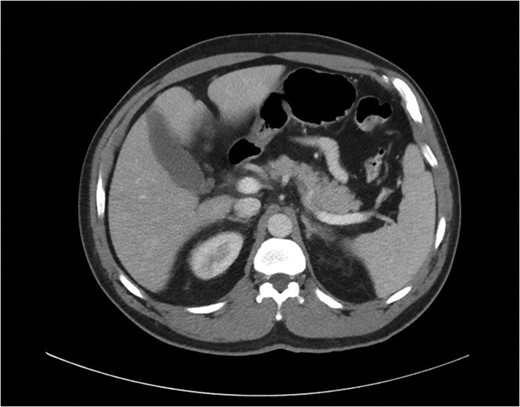 Preoperative CT scan of abdomen.