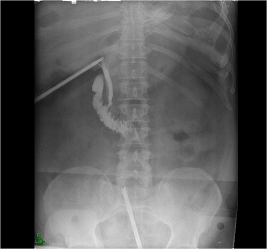 Intra-operative cholangiogram showing good flow of bile into duodenum.
