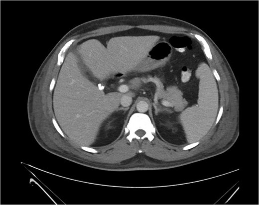 Post-operative CT scan.