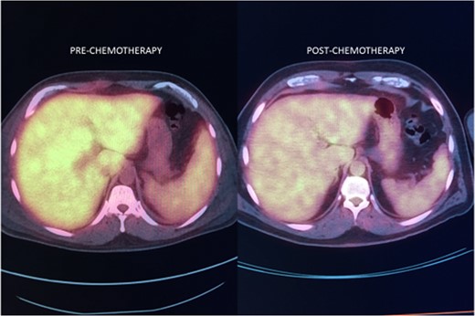 Pre (left) and post (right) treatment PET scans of liver.