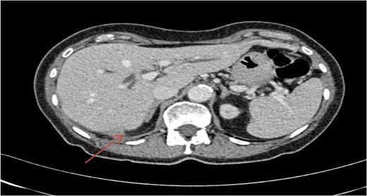 CT scan of abdomen showing soft tissue mass posterior to liver.
