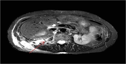 MRI of abdomen showing right retroperitoneal collection extending into right flank.