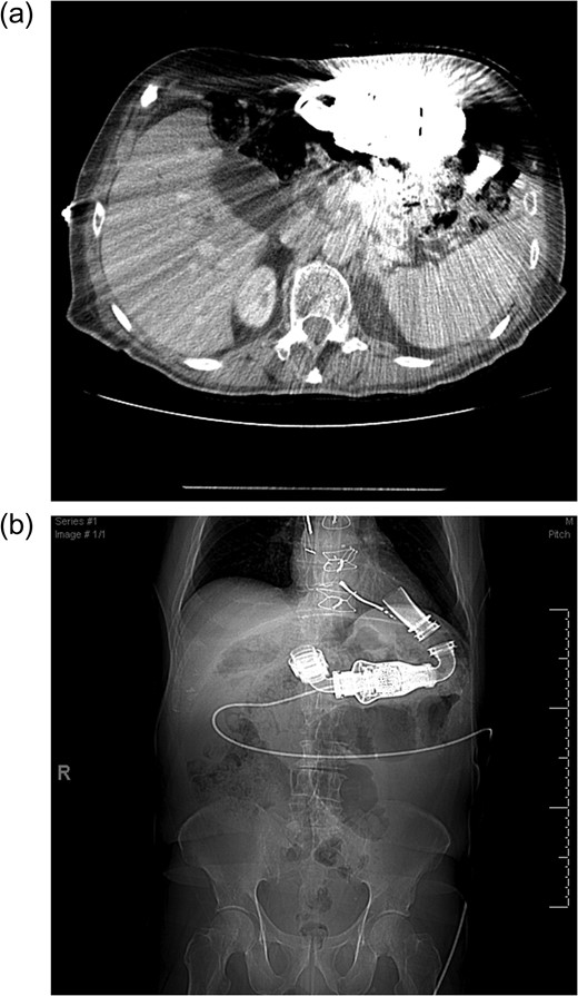 (a) Cross sectional imaging as a pre-operative study to define the pancreatic anatomy is limited by the LVAD artifact. (b) Computed tomography scout film shows the location of the LVAD and LVAD driveline in the chest and abdomen.