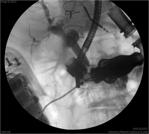 ERCP images illustrate the common bile duct with distal stricture, partially obstructed by the LVAD.