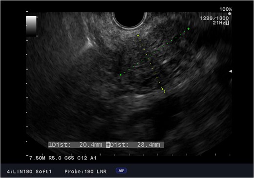 Endoscopic ultrasound images of the adenocarcinoma of the head of the pancreas.