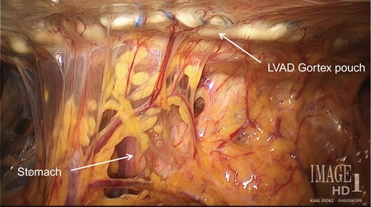 A pouch made of Gortex and secured to the inferior face of the diaphragm houses the LVAD and sits over the mid and upper quadrants of the abdomen.