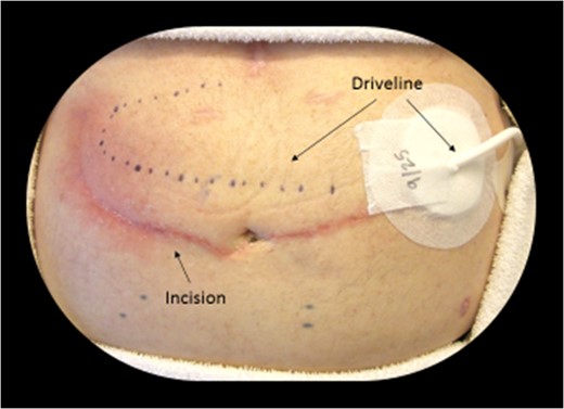 Dotted line shows the subcutaneous location of the driveline (LVAD power cord). A typical midline incision or subcostal incision was not feasible due to the driveline trajectory.