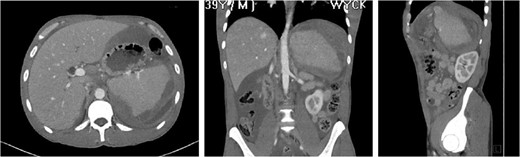 Initial computed tomography of the abdomen and pelvis.