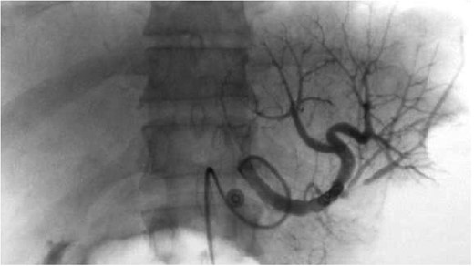 Splenic artery angiogram after placement of embolization coil showing patency of flow, no active extravasation.