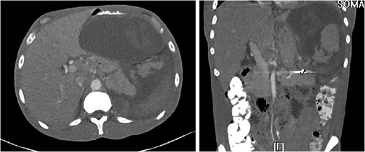The ‘Islands’ of preserved spleen lit up with IV contrast surrounded by a large collection of old blood and devitalized tissue.