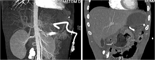 3D reconstruction and coronal CT after placement of pigtail drainage catheter.