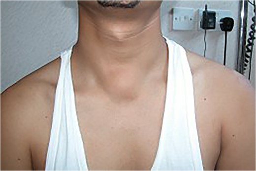 The appearance of suprasternal midline neck lump pre Valsalva manoeuvre.