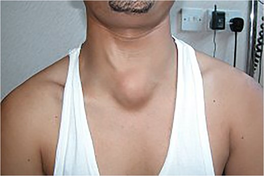 The midline neck lump is more prominent at Valsalva manoeuvre.