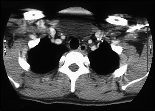 Cross-sectional image of midline neck lump with no tracheal communication.