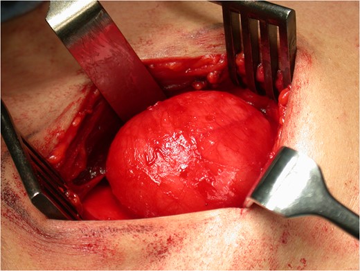 Intra-operative image of bronchogenic cyst prior to surgical excision.