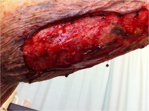 Extent of surgical debridement is illustrated, with new areas of necrosis evident within 24 h.