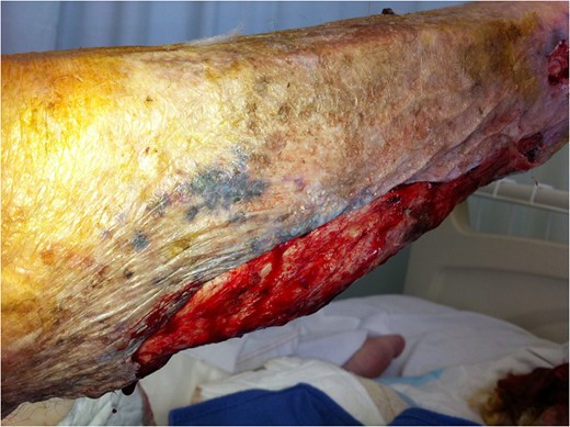 Extent of surgical debridement is illustrated, with new areas of necrosis evident within 24 h.