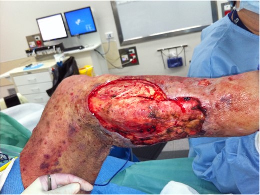 Further debridement underway. New areas of necrosis on medial upper thigh not illustrated.