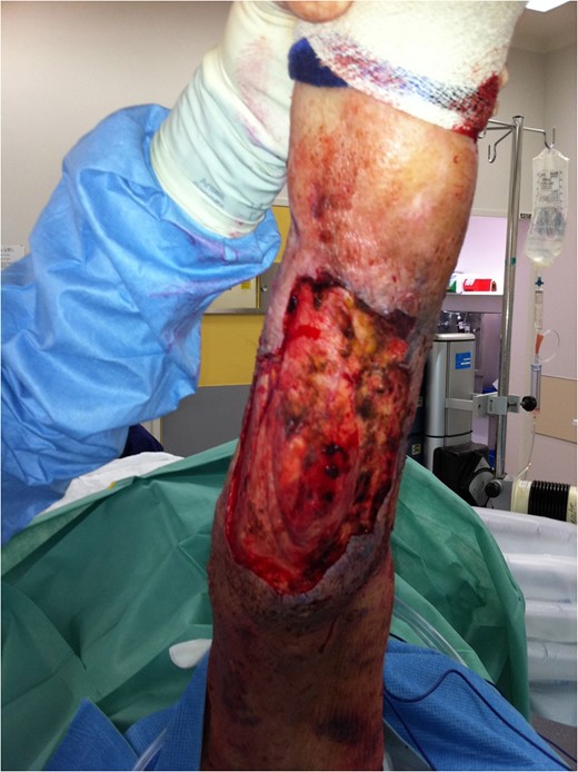 Further debridement underway. New areas of necrosis on medial upper thigh not illustrated.