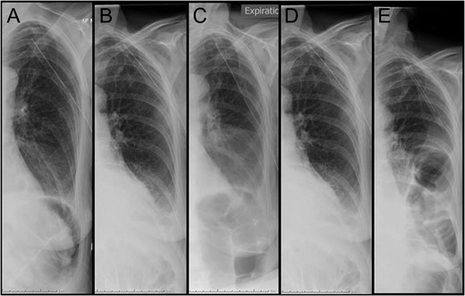 Daily chest x-ray documenting the left hemithorax. (A) Day 3 post admission: immediately post insertion of intercostal catheter. (B–D) consecutive chest x-ray on Days 4, 5 and 6 post admission. (E) Day 7 post admission: diagnostic of bowel loops in left hemithorax.