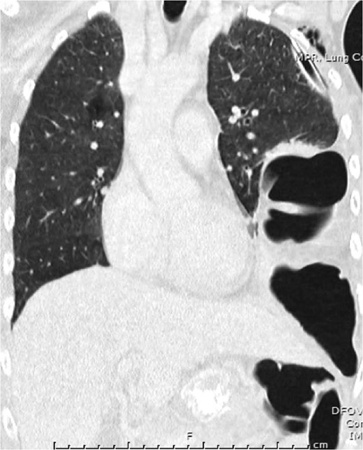 Representative coronal slice of computed tomography confirming the presence of a traumatic diaphragmatic hernia with a loop of incarcerated colon in the left hemithorax.