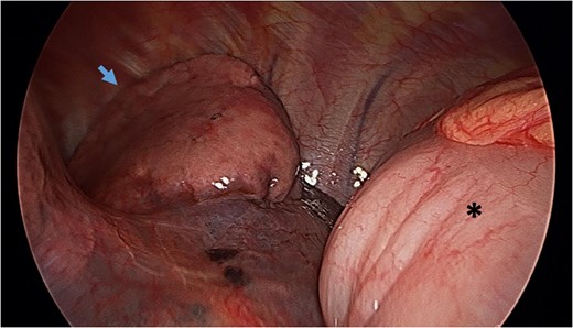 Video-assisted thoracoscopy (VAT) demonstrating a loop of transverse colon in the left hemithorax. Black asterisk (*) indicates a loop of transverse colon. Blue arrow indicates deflated left lung.