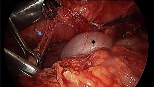 Reduction of transverse colon into abdominal cavity. The spleen is visible adjacent to the transverse colon. Black asterisk (*) indicates a loop of transverse colon. Blue broken arrow indicates the diaphragmatic defect that was extended to successfully reduce the colon.
