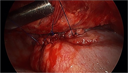 Tension-free primary suture repair of the diaphragmatic defect.
