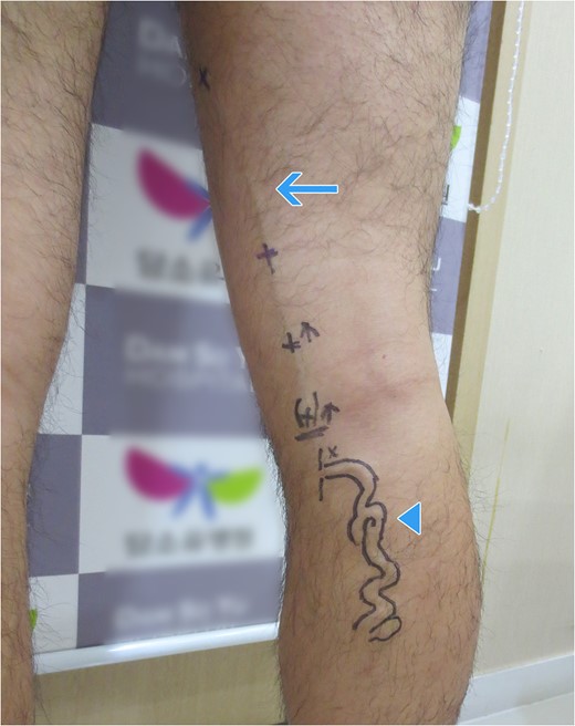 Photograph of posterior accessory saphenous vein (arrow) and its tributary (arrow head).
