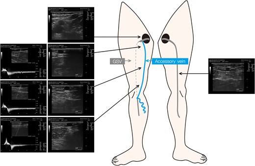 Schema of the right limb veins and findings of duplex ultrasonography. Dotted gray line represents the hypoplastic segment of the GSV and solid blue line represents the posterior accessory saphenous vein.