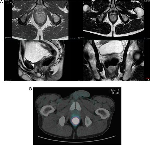(A) T2-weighted axial, coronal and transverse MRI images, demonstrating the polypoid 3 cm anorectal mass. (B) PET–CT showed an intensely hypermetabolic lesion centered on the lower rectum.