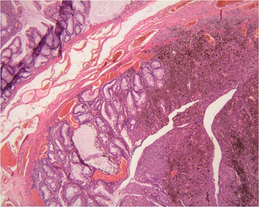 Histologic illustration of the collision tumour.